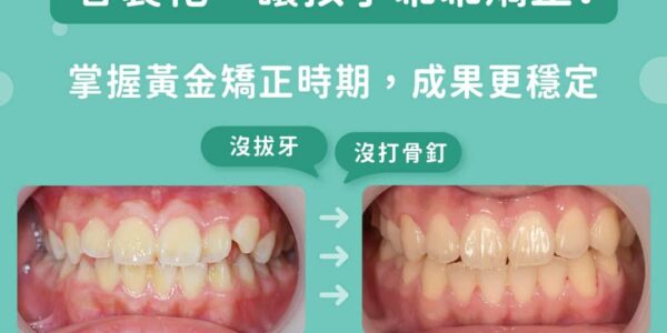客製化，讓孩子乖乖矯正！掌握黃金矯正時期，成果更穩定