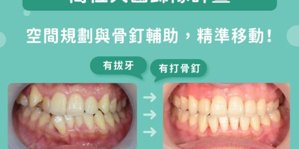 高位犬齒歸隊計畫：空間規劃與骨釘輔助，精準移動！