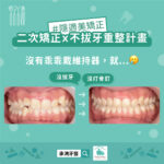 二次矯正x不拔牙重整計畫