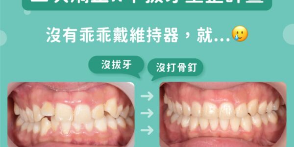 二次矯正x不拔牙重整計畫