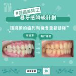 暴牙感降級計畫，讓擁擠的齒列有機會重新排隊