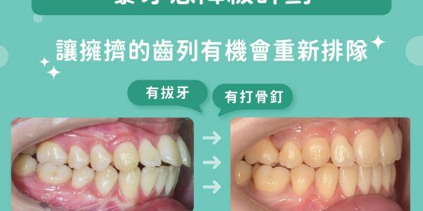 暴牙感降級計劃，讓擁擠的齒列有機會重新排隊