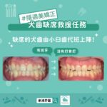 🦷 天生缺牙一定要植牙嗎？台中蔡宜廷醫師：隱適美「犬齒缺席救援任務」免打骨釘也能矯正變美！