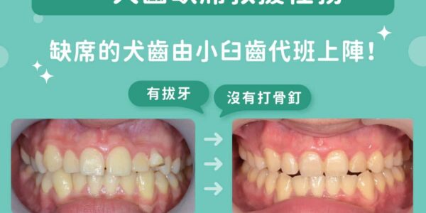 🦷 天生缺牙一定要植牙嗎？台中蔡宜廷醫師：隱適美「犬齒缺席救援任務」免打骨釘也能矯正變美！