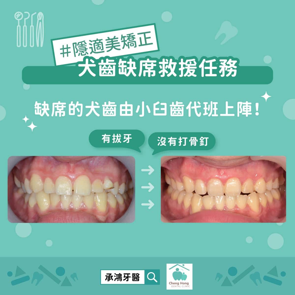 犬齒缺席救援任務，缺席的犬齒由小臼齒代班上陣