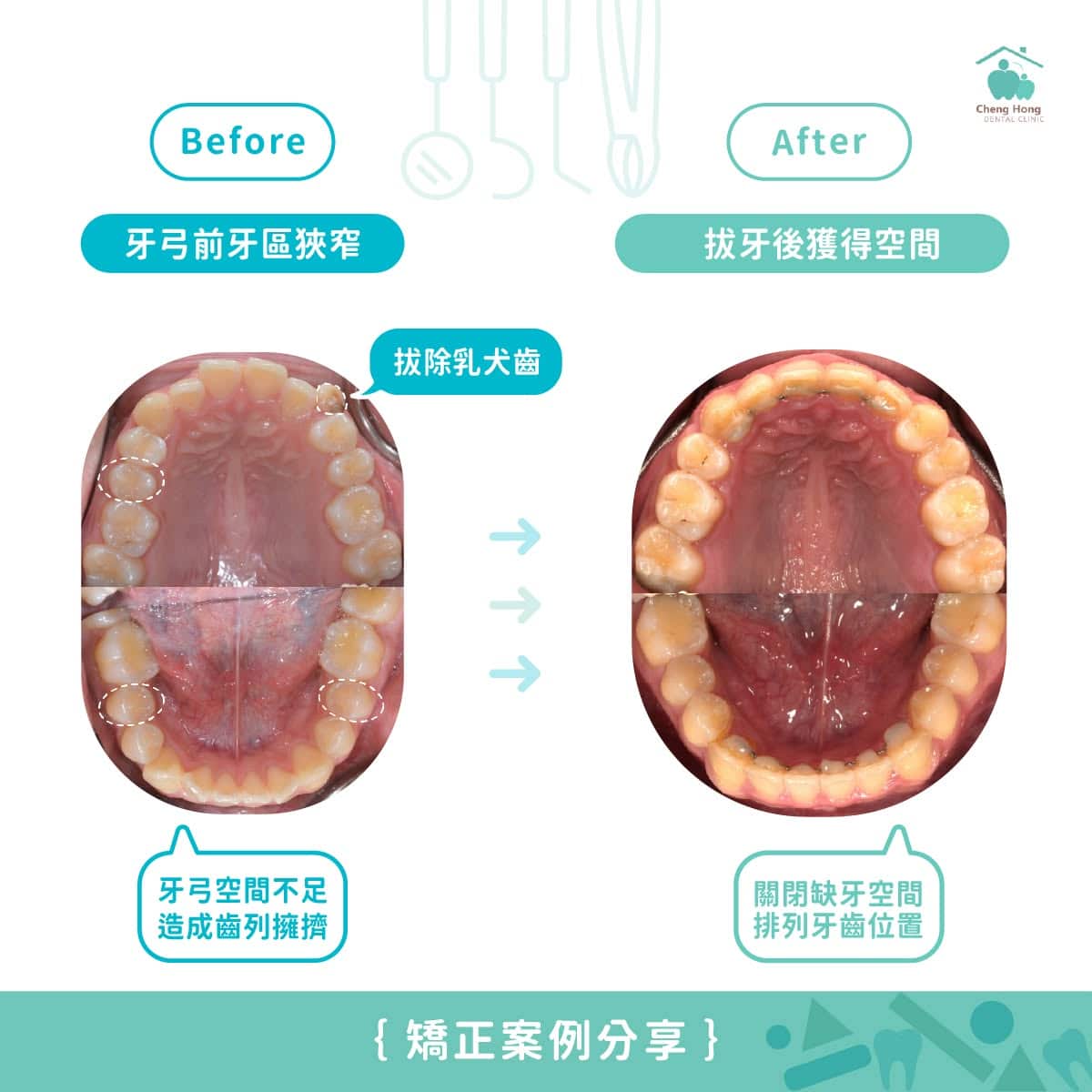犬齒缺席救援任務，缺席的犬齒由小臼齒代班上陣