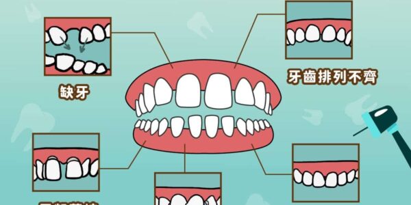 牙縫變大、卡菜渣說話漏風怎麼辦？台中蔡宜廷醫師解析5大牙縫變大原因