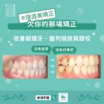 隱適美不拔牙的微調魔法：台中蔡宜廷醫師帶你告別尷尬蝴蝶牙