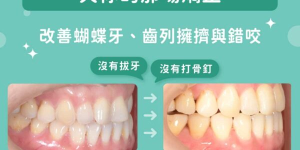 欠你的那副整齊門牙，這次總算補上了！