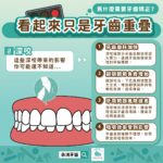 上排牙齒蓋住比較多，只是「深咬」需要矯正嗎？台中蔡宜廷醫師解析 4 大隱藏危機與矯正對策