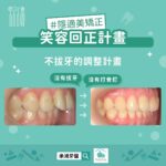 矯正一定要拔牙、打骨釘嗎？