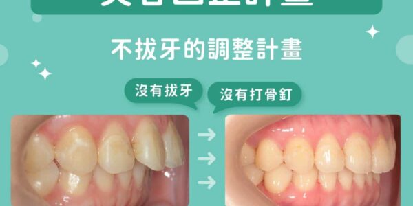 矯正一定要拔牙、打骨釘嗎？台中蔡宜廷醫師隱適美「不拔牙不打骨釘」笑容回正紀錄