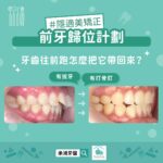 隱適美矯正前牙歸位，牙齒往前跑怎麼把他帶回來