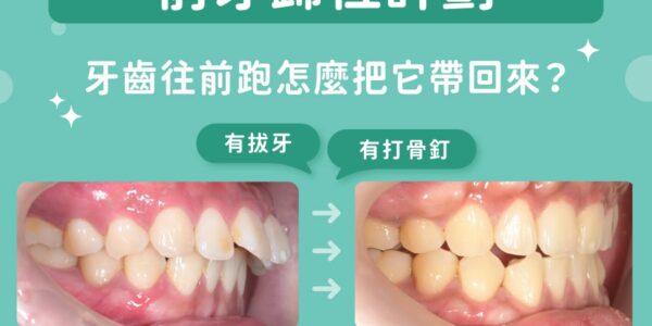 門牙外翻除了排整齊還能怎麼調？台中北區承鴻牙醫蔡宜廷醫師的「前牙歸位計劃」