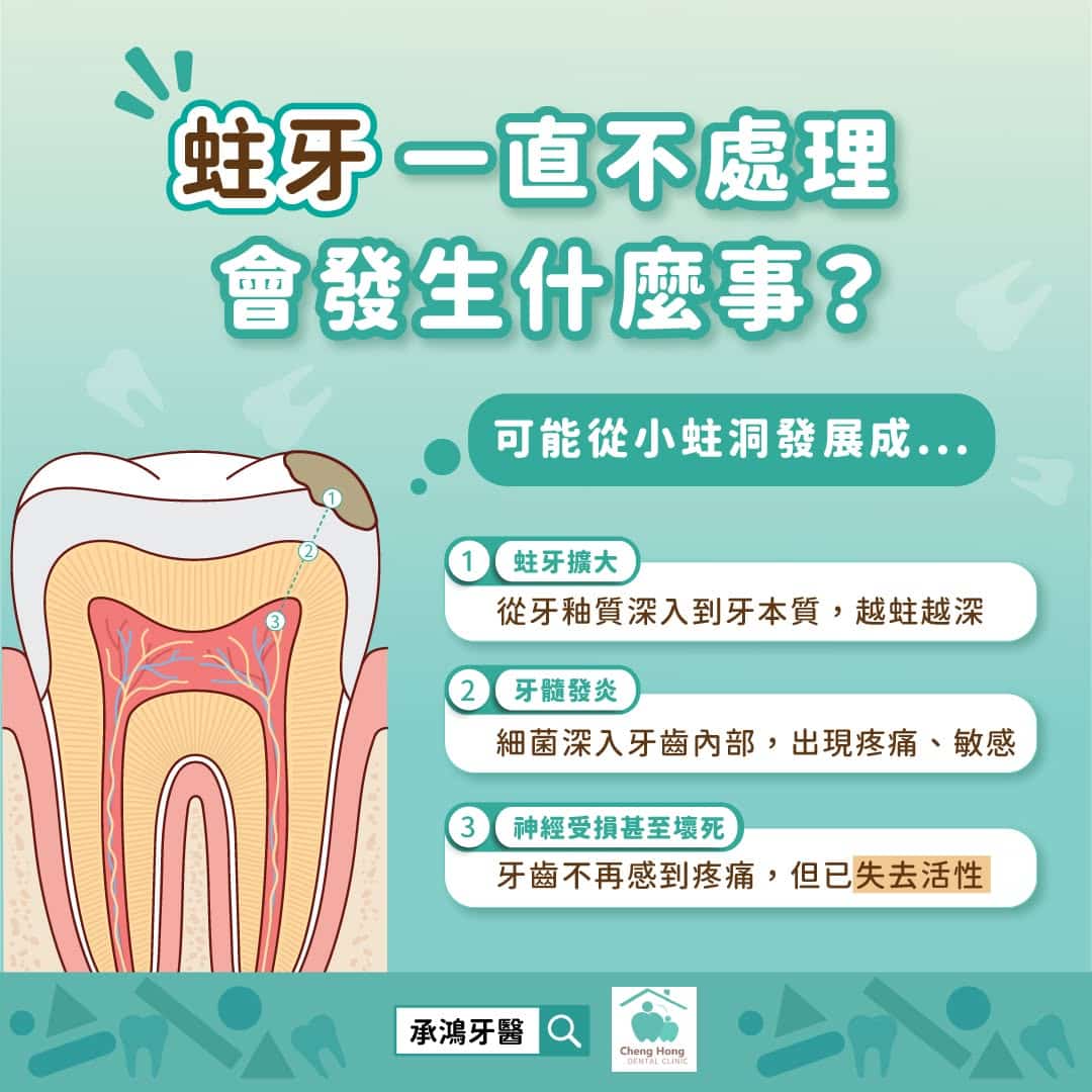 蛀牙一直不處理會發生什麼事？
