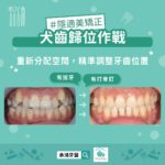 犬齒規劃作戰，重新分配空間，精準調整牙齒位置