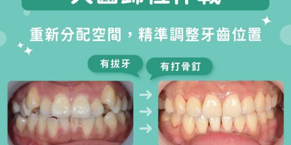 犬齒長太高、位置偏掉怎麼辦？台中北區承鴻牙醫蔡宜廷醫師：犬齒歸位作戰