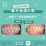 暴牙後退計畫，後退了，咬合也重新定位！