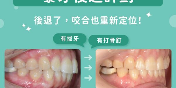 暴牙後退計劃！拔牙、骨釘搭配隱適美，蔡宜廷醫師的齒列調整心法