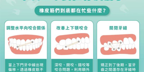 矯正後期為什麼要拉橡皮筋？蔡宜廷醫師解析調整咬合與關牙縫的關鍵作用