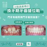 換牙期牙齒搶位戰，門牙有縫而側門牙躲到後面？