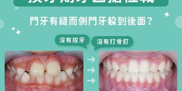 兒童換牙期齒列擁擠、大門牙縫怎麼辦？蔡宜廷醫師談混合齒列期隱適美不拔牙早期矯正
