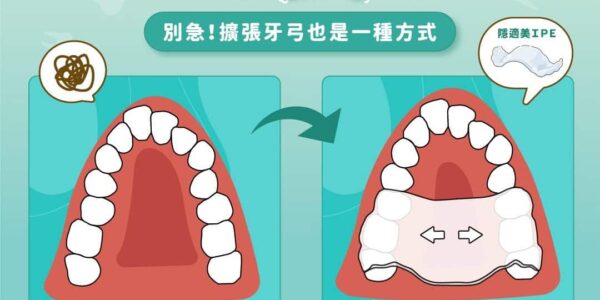 孩子牙齒太擠長大一定要拔牙嗎？蔡宜廷醫師談 6–11 歲兒童隱適美擴弓（Invisalign Palatal Expander）