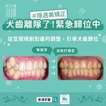 從空間規劃到齒列調整，引導犬齒歸位