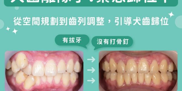 犬齒長在牙齦上方變成虎牙？蔡宜廷醫師解析高位犬齒搭配隱適美歸位矯正